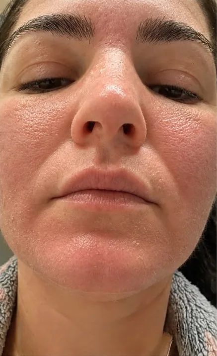 Korean Algae Peeling: pielea imediat după tratament, ușor înroșită