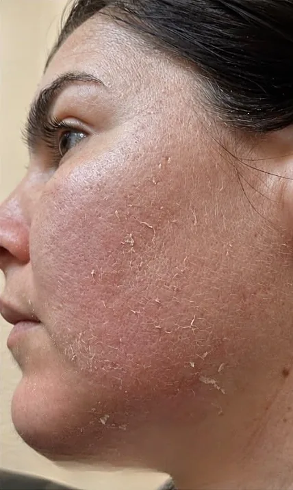 Korean Algae Peeling: pielea în faza de exfoliere după peeling