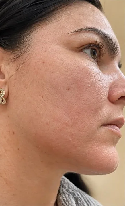 Korean Algae Peeling: pielea înainte de tratament